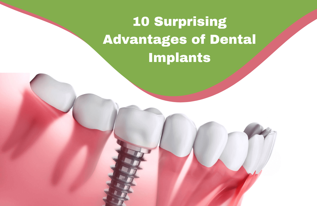 Benefits of Dental Implants