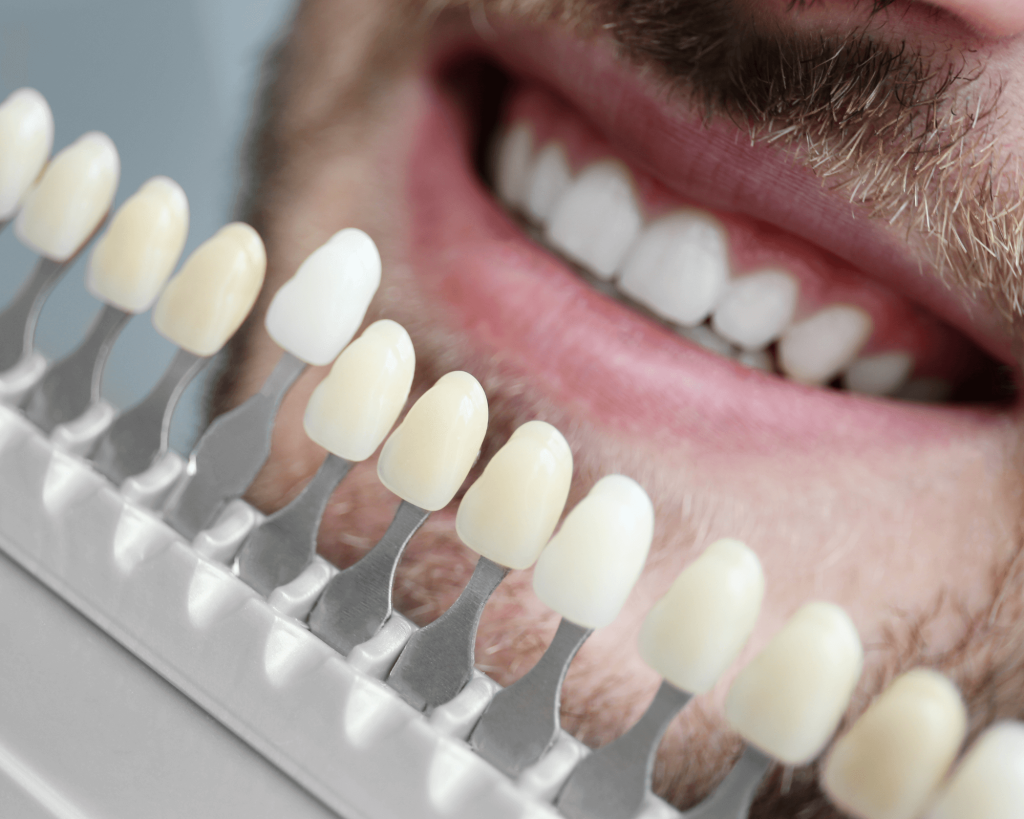 What is a Composite Veneers