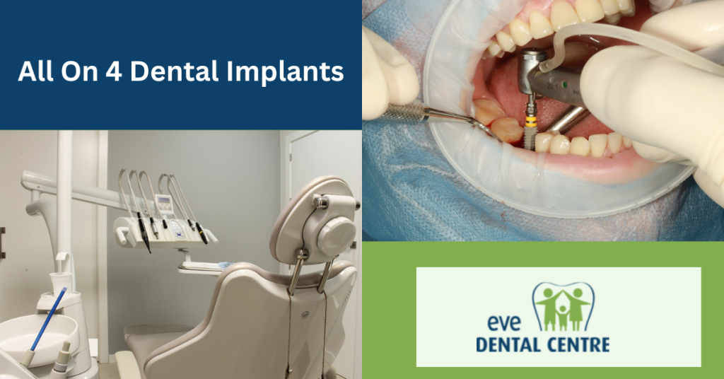 All On 4 Dental Implants