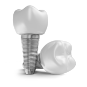 Dental Implant