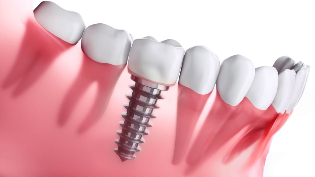 How Much Does Dental Implants Cost