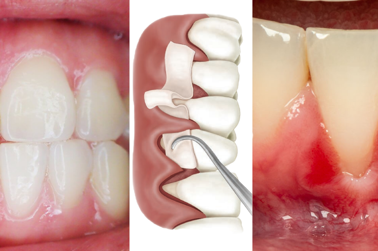 Receding Gums Treatment at Eve Dental Centre