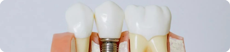 Top-rated and Specialised in Dental Implants