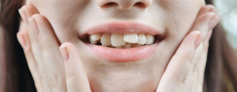 Can You Get Veneers on Crooked Teeth