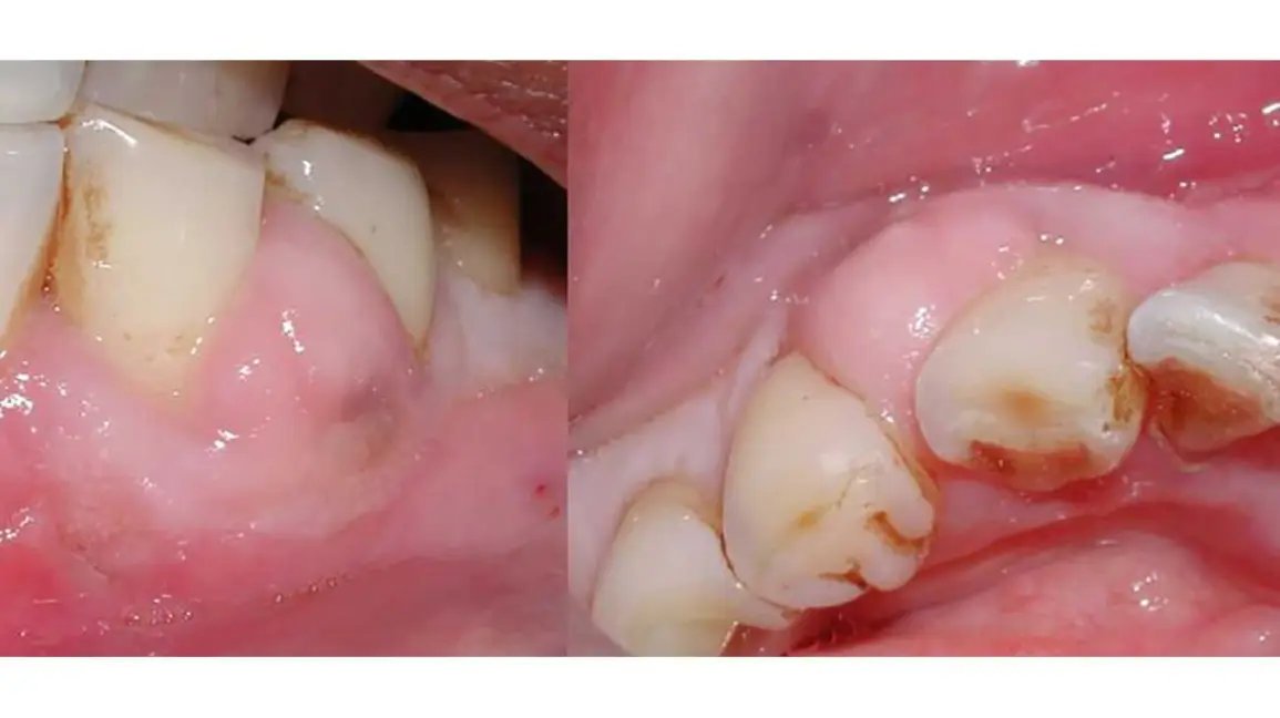 Gum Infections