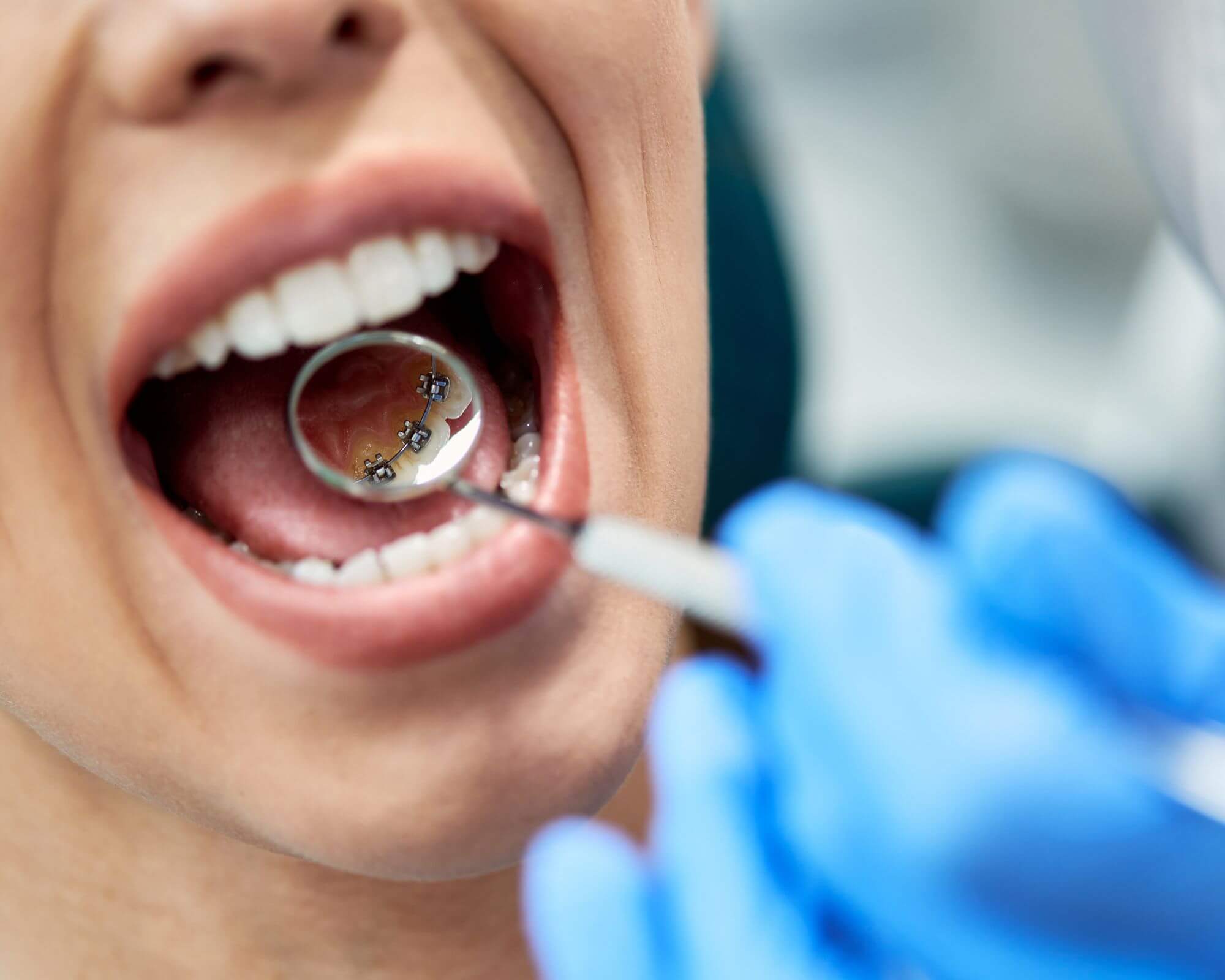 Dental Crowns